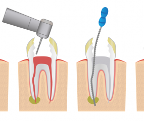 Endodoncia