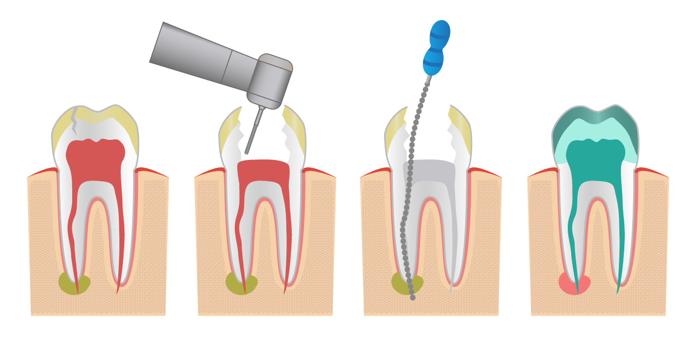 Endodoncia