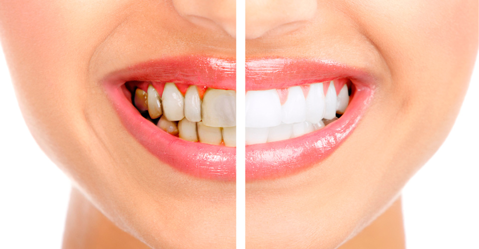 Rehabilitacion oral